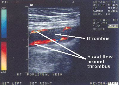 What is deep vein thrombosis? DEEP VEIN THROMBOSIS : - Mobile Physiotherapy Clinic ...
