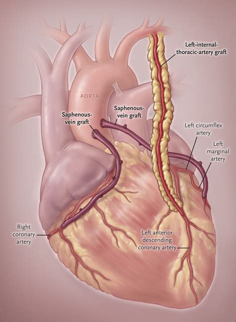 Coronary Artery Bypass Grafting Nejm