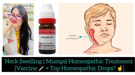 Neck Swellingthroat Pain In Kids Mumps Homeopathic Medicine Parotid