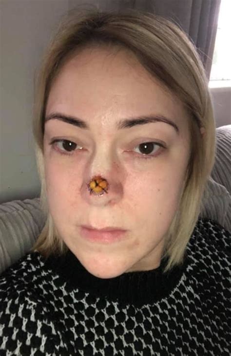 Mum Discovers Nose Blemish Was Actually Flesh Eating Skin Cancer The