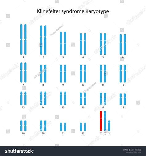 Xxyklinefelter Syndrome 인간 핵 유형 스톡 일러스트 2214587561 Shutterstock