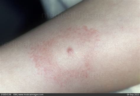 Stock Image Lyme Disease Rash Erythema Migrans On The Arm 132122