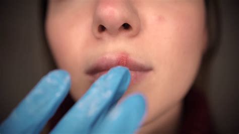 Herpes On Lips Part Of Womans Face With Stock Footage Sbv 329122324