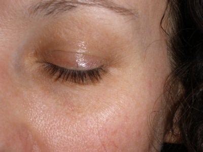 Brownish Yellow Discoloration Of Bilateral Oeruorbital Region Of Eyes