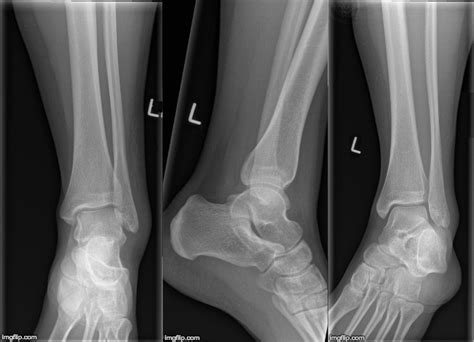 Emrad Radiologic Approach To The Traumatic Ankle Med Tac