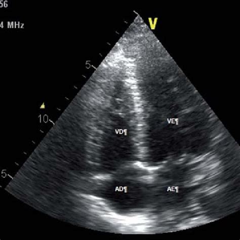 Transthoracic Echocardiogram In 4 Chamber Apical View Showing No