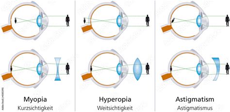 the visual defects myopia hyperopia and astigmatism and how to correct it with biconcave and