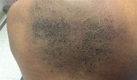Derm Dx Dirty Skin That Cannot Be Washed Clinical Advisor