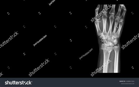 Film X Ray Wrist Radiograph Show Stock Photo 1608841024 Shutterstock