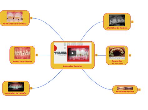 Anomalias Dentales Mind Map