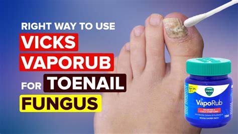 Use These 7 Ways To Get Rid Of Nail Fungus Opera News
