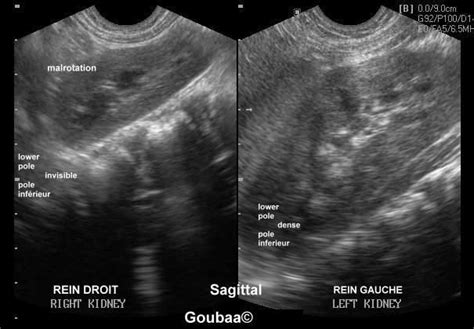 Horseshoe Kidney Ultrasonography Urinary Malformation Rein En Fer à