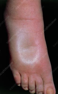 A Swollen Foot In A Case Of Pitting Oedema Stock Image M230 0018