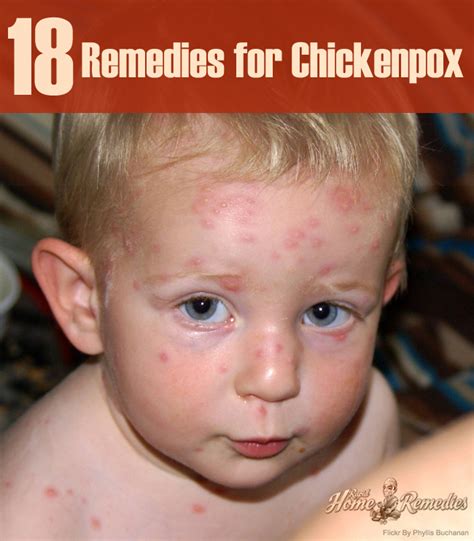 18 Simple Home Remedies For Chickenpox