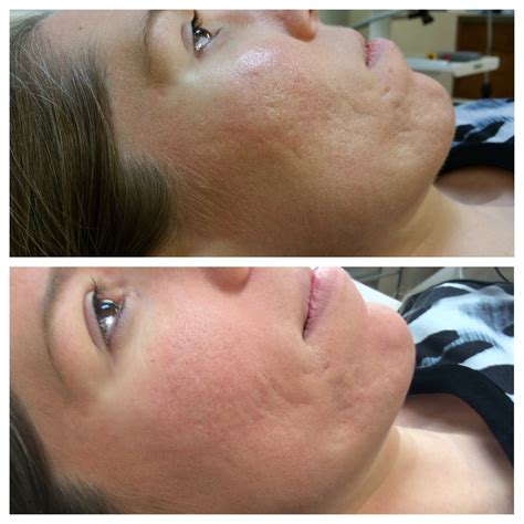 Fractional Laser Scar Treatment Services Skin Resurfacing