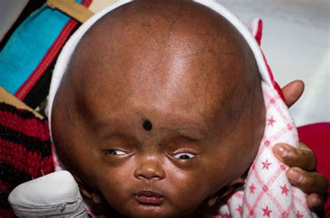 Indian Boy Ankit Minj Has Head Triple In Size Due To Rare Condition