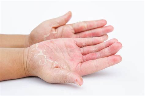 Fungal Skin Infection Hand