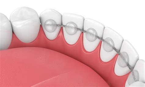Maybe you would like to learn more about one of these? How Long Do You Have to Wear a Retainer? | Premier ...