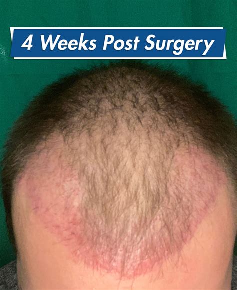 Redness After Hair Transplant How To Reduce Redness And How Long It Lasts