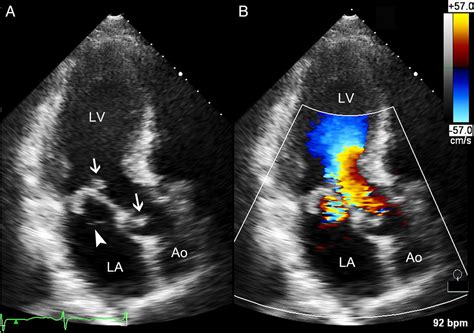 Large Mitral Valve Aneurysm With Infective Endocarditis Bmj Case Reports
