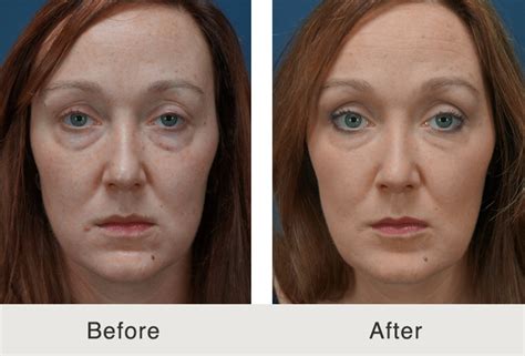 Before And After Full Facial Fillers Carolina Facial Plastics