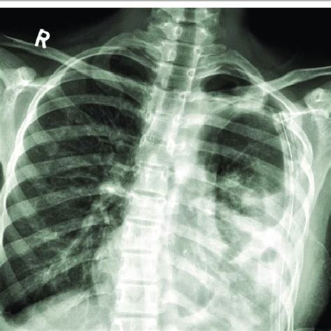 Chest X Ray Image Of The Extrapulmonary Intrathoracic Hydatid Cyst In
