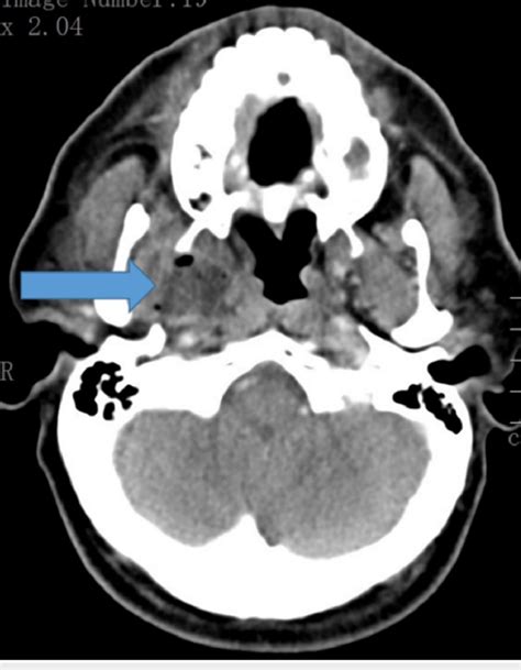 Ct Scan Of Head Axial View Showing Right Parapharyngeal Abscess
