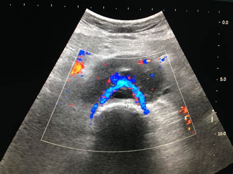 Vietnamese Medic Ultrasound Case 458 Periaortic Lymphoma Dr Phan