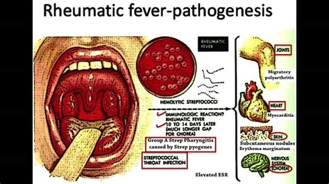 Rheumatic Fever Usmle Highly Tested Topic Youtube