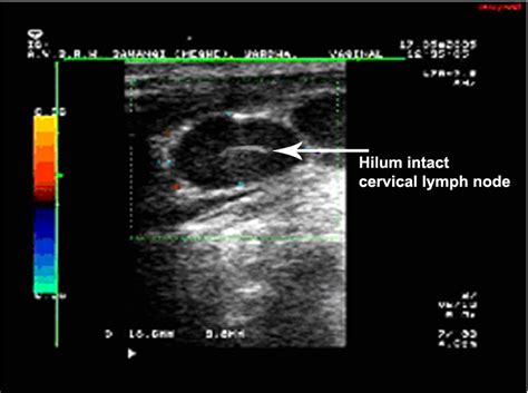 Utility Of Color Doppler Ultrasound In Evaluating The Status Of