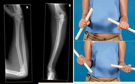 Pediatric Forearm Fractures Musculoskeletal Key