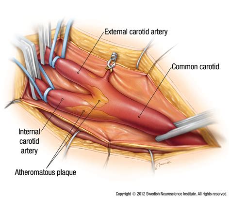 They originate from the carotid bifurcation, travel through the. What is carotid artery disease? | Swedish Medical Center Seattle and Issaquah