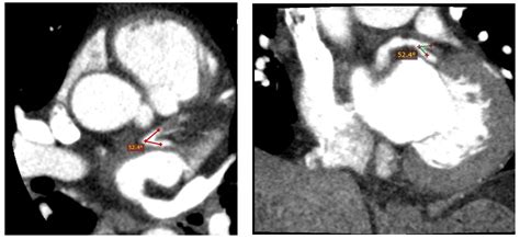 JCM | Free Full-Text | Evaluation of the Relationship between Left