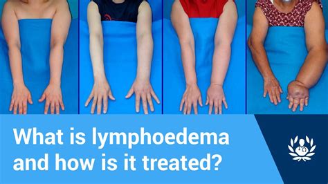 What Is Lymphoedema And How Is It Treated Youtube