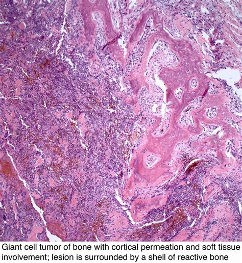 Pathology Outlines Giant Cell Tumor Of Bone
