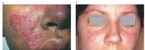 Nov 12, 2018 · what is lupus? Systemic Lupus Erythematosus Part 2