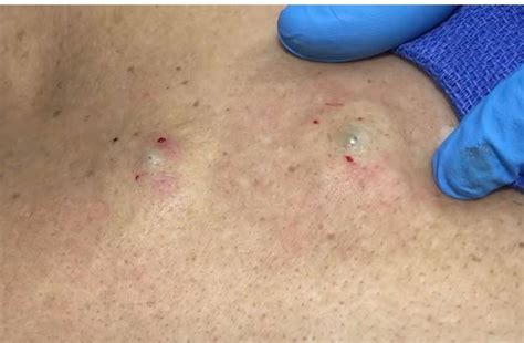 Twin Blackheads Cyst On The Back Removed New Pimple