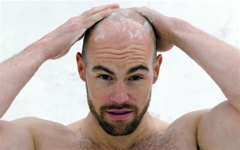 Can Bald People Get Dandruff
