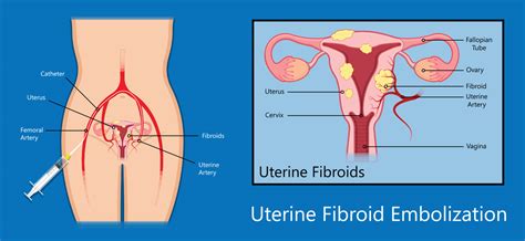 Uterine Fibroid Embolization Northwest Radiology Indianapolis Carmel Fishers