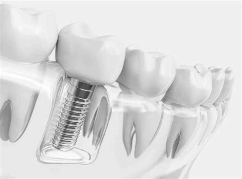 How Long Do Dental Implants Last Today Dental News Network