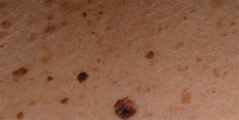 Mole Removal In London Linia Skin Clinic