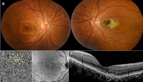 A 41 Year Old Female Patient With Pxe A Color Fundus Photography