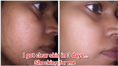 3 Days Challengehow To Achieve Glass Skin With Natural Ingredients