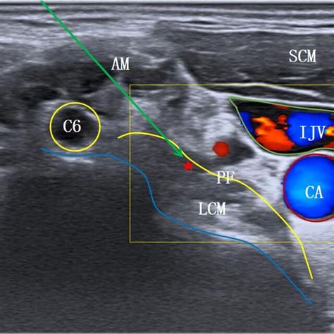 The Level At C7 Transverse Process Am Anterior Scalene Muscle Scm
