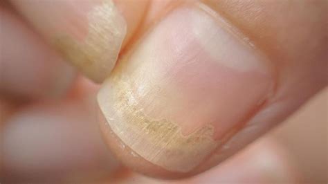 Cuáles son las infecciones de la piel producidas por hongos más comunes