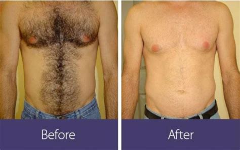 Laser Hair Removal Results After First Treatment