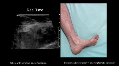 Dynamic Ultrasound Imaging Of Peroneus Longus Muscle Herniation Youtube