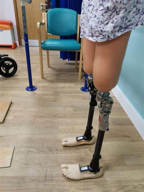 Mum Who Lost Both Legs After Horror House Fire Says It Has Made Her Life Better Mirror Online