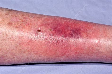 Cellulitis Of The Leg Stock Image C0345306 Science Photo Library