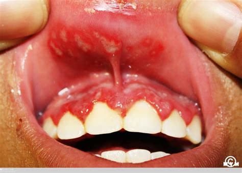 Herpetic Gingivostomatitis